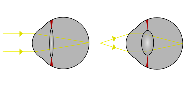 Что такое анизометропия?
