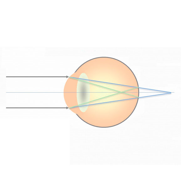 Смешанный астигматизм - что это?